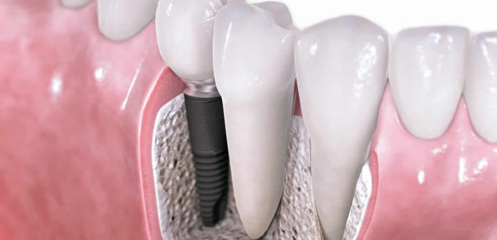 6 consejos para cirugía de implantes dentales