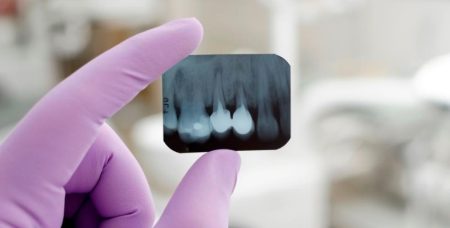 La Importancia de la Radiografía Dental Una Herramienta Clave en Tu Salud Bucal